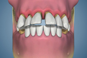 Anterior Teeth Splaying